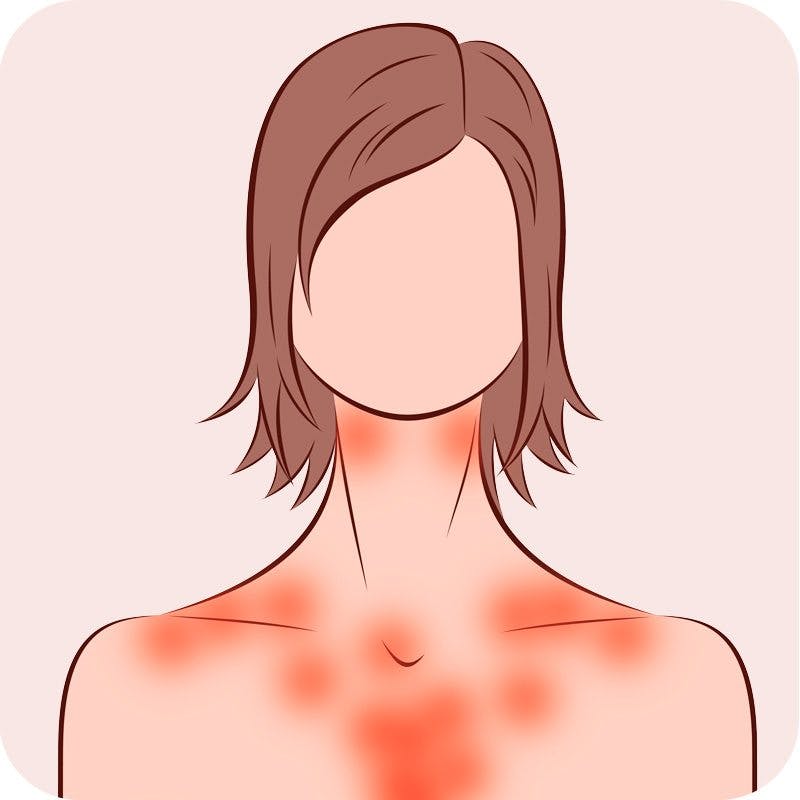 Keto Rash